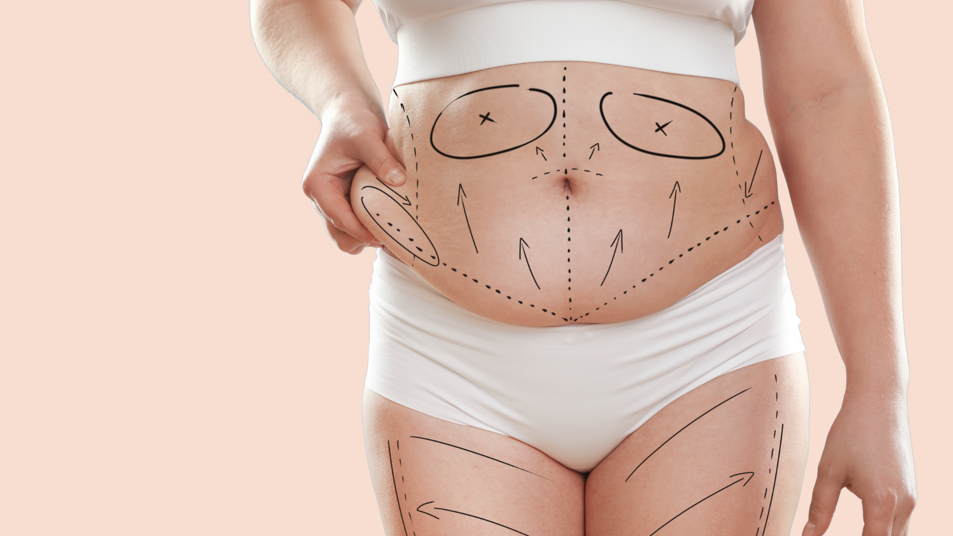 Abdominoplastie Geneve Dr Thomet