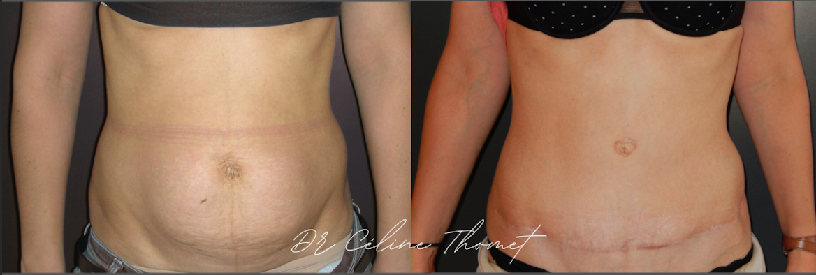 Abdominoplastie 1 Abdominoplastie Geneve avant apres face Dr Thomet