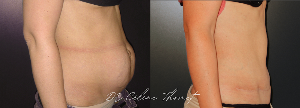 Abdominoplastie 2 Abdominoplastie Geneve avant apres profile Dr Thomet