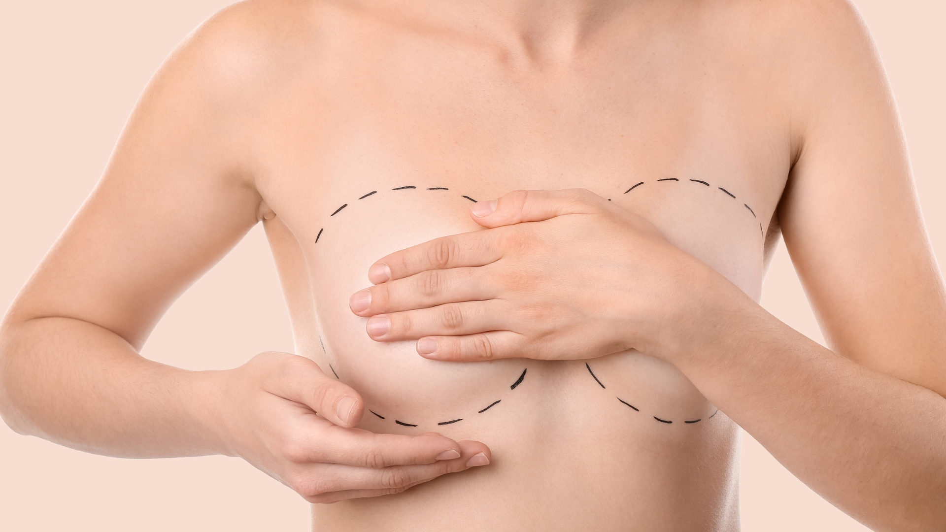 Retrait de prothèses mammaires 3 Augmentation mammaire lipofilling Geneve Dr Thomet