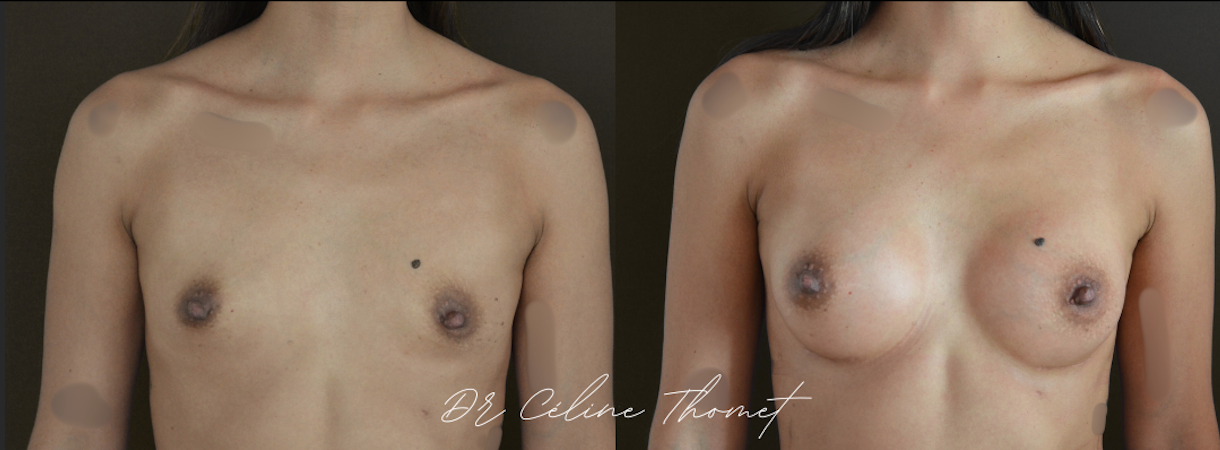 Augmentation mammaire par prothèses 1 Augmentation mammaire protheses Geneve avant apres face Dr Thomet