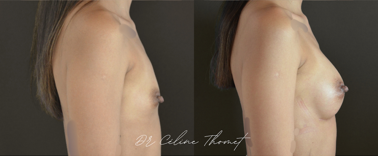 Augmentation mammaire par prothèses 3 Augmentation mammaire protheses Geneve avant apres profile Dr Thomet
