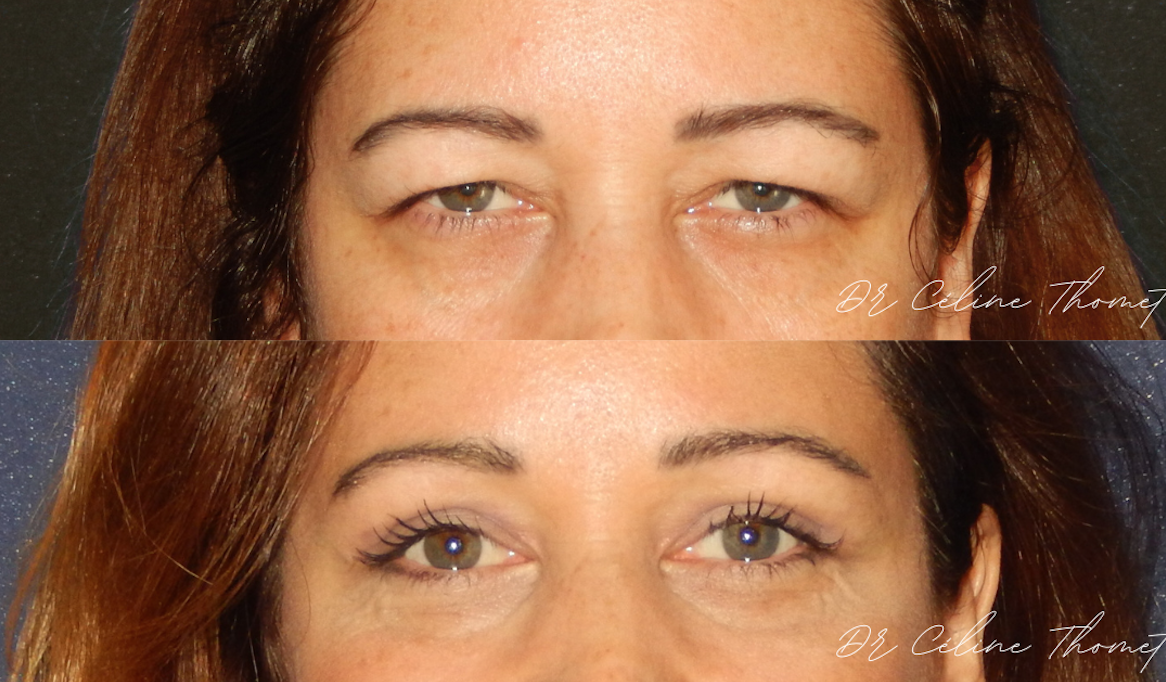 Blepharoplastie avant apres Geneve Dr Thomet