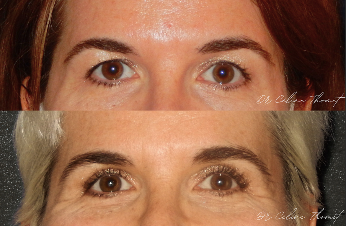 Blepharoplastie esthetique Geneve Dr Thomet