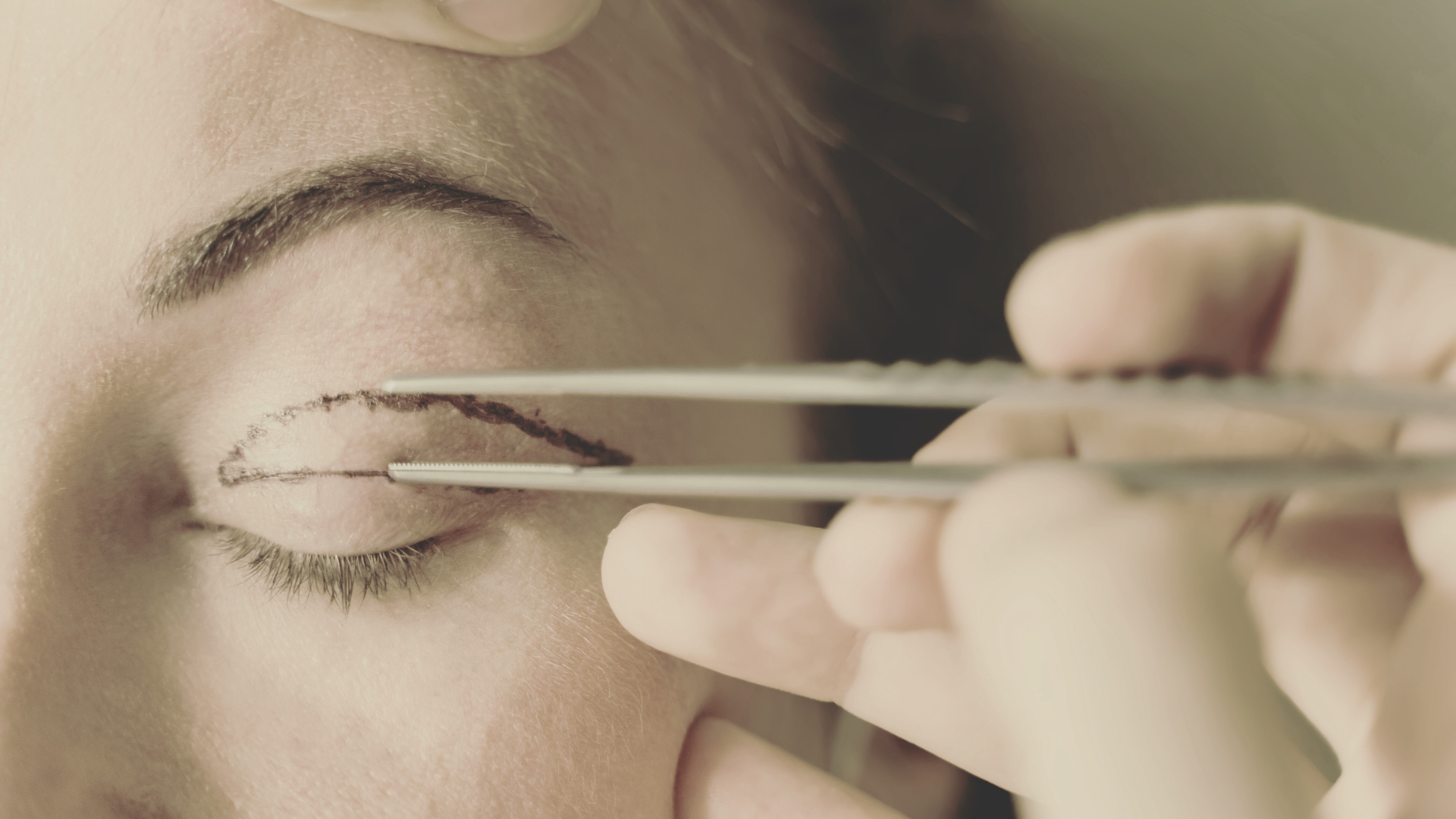 Blepharoplastie paupieres Geneve Dr Thomet