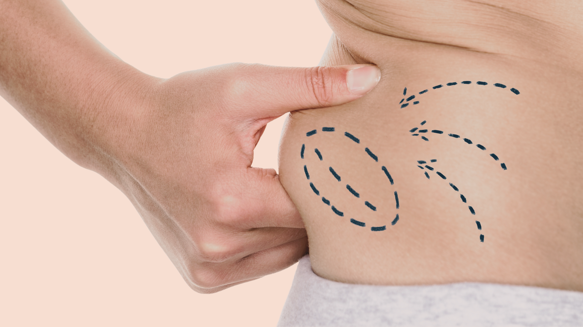 Liposuccion Geneve Dr Thomet