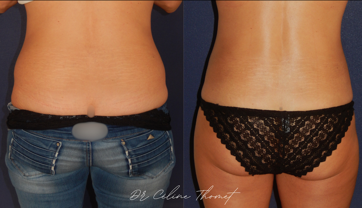 Liposuccion 3 Liposuccion flancs Geneve avantt apres dos Dr Thomet