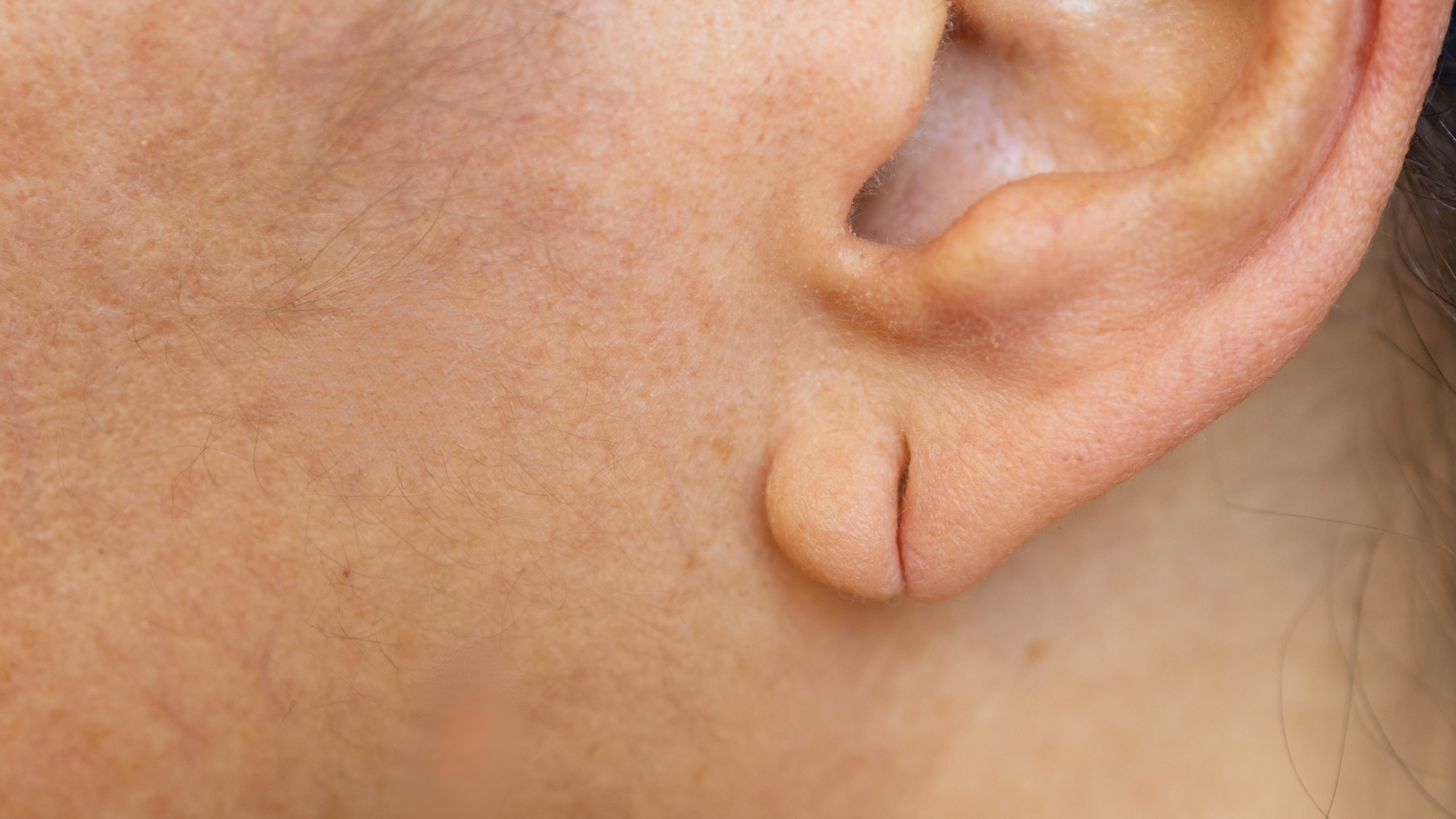 Otoplastie 1 Lobe doreille dechire fendu Geneve Dr Thomet