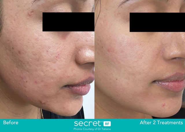 Secret Pro avant apres cicatrices acne laser micronnedling radiofrequence