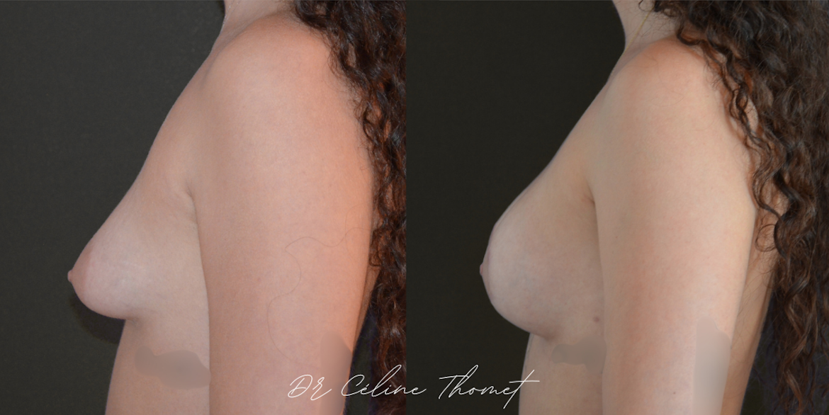 Reconstruction de seins tubéreux 3 Seins tubereux protheses Geneve avant apres profile Dr Thomet