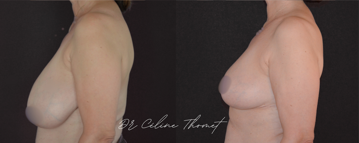 reduction mammaire profile avant apres Geneve Dr Thomet