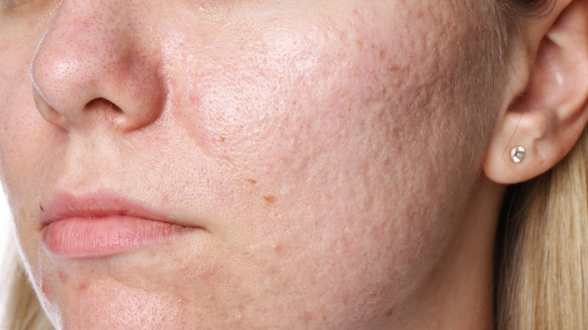 Cicatrices acne visage