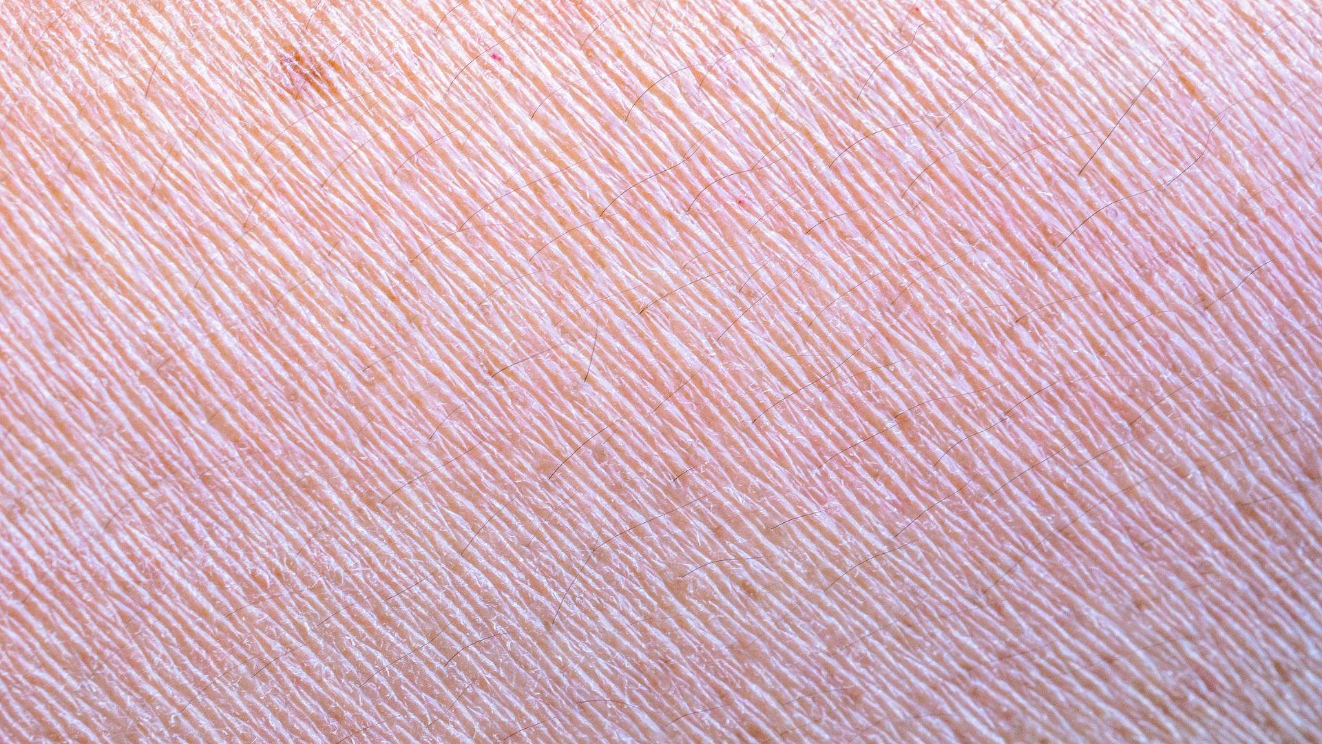 Peau deshydratee 1