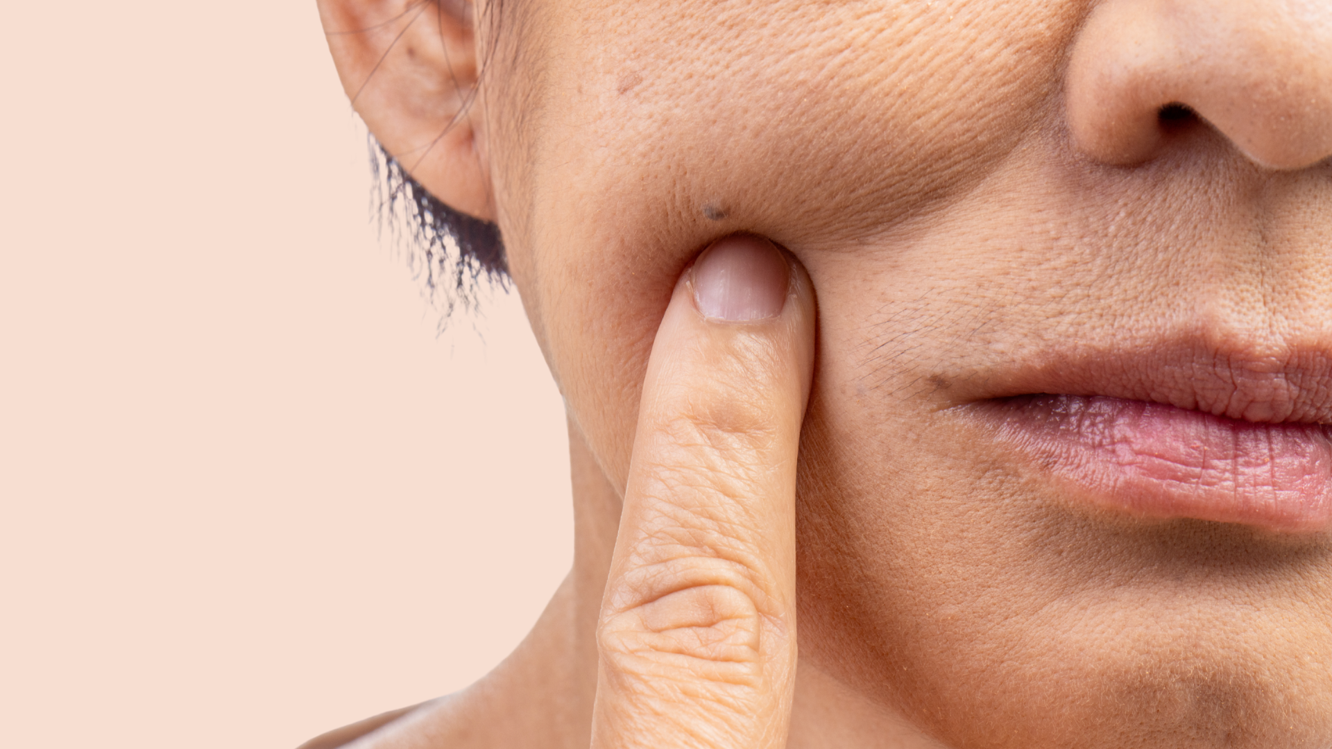 Perte de volume visage